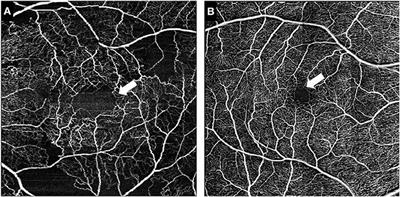 Optical coherence tomography angiography biomarkers of microvascular alterations in RVCL-S